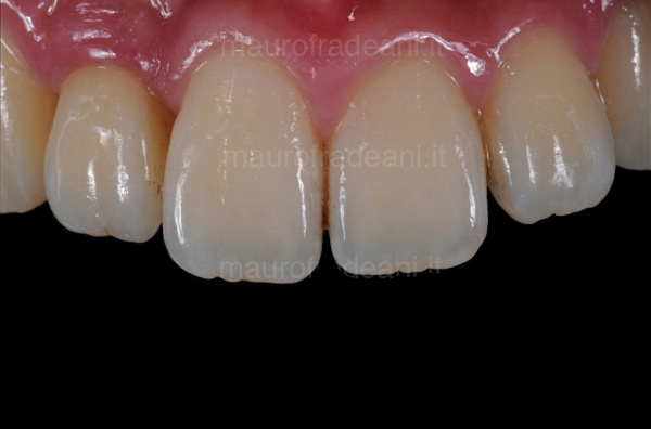 Dr. Fradeani dental implant in the anterior sector clinical case