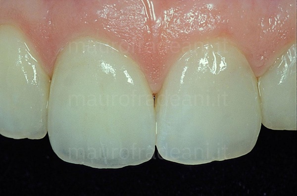 Clinical case ceramic dental crowns treatment with dental capsules Dr. Fradeani