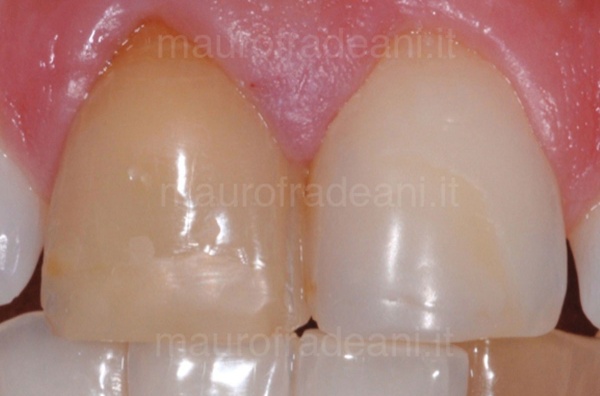 Clinical case whitening in the devitalized tooth clinic Dr. Mauro Fradeani