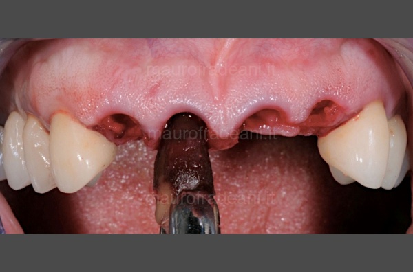 Ceramic crowns on implants clinical case Dr. Mauro Fradeani