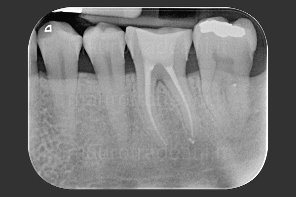 foto-post-trattamento-endodontico