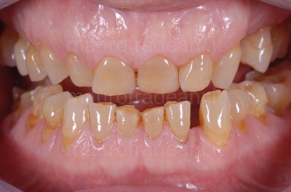 Clinical case aesthetic-functional rehabilitation for dental wear Dr. Fradeani