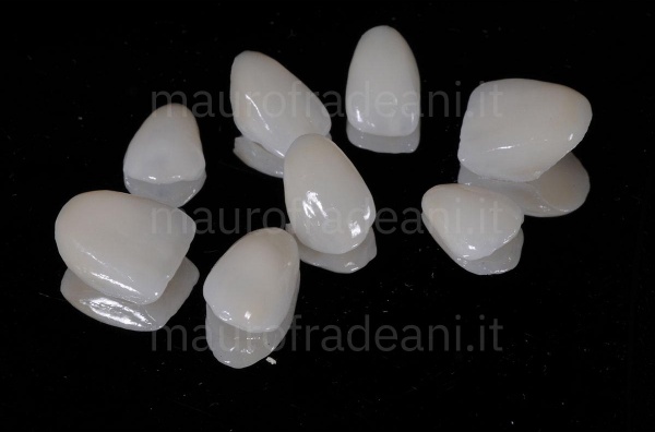 porcelain-dental-veneers-on-a-patient-with-discolouration-clinical-case-fradeani-clinic