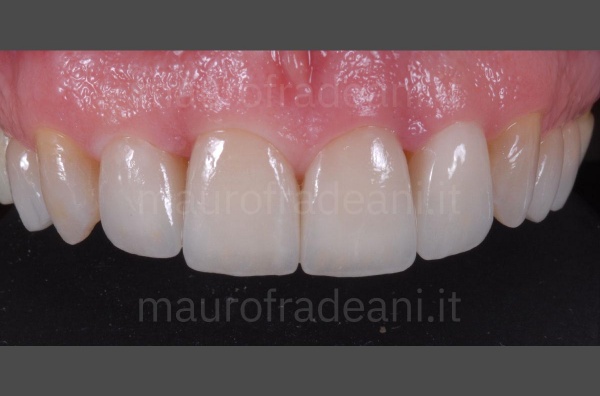 Fradeani Dental Clinic upper teeth veneers clinical case 