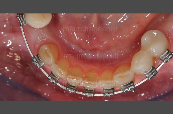 pre-prosthetic-orthodontics-clinical-case-dr-mauro-fradeani-after