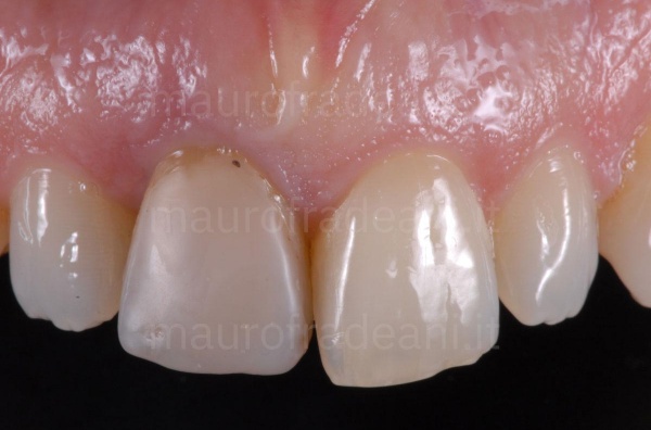 Ceramic dental crown on implant clinical case