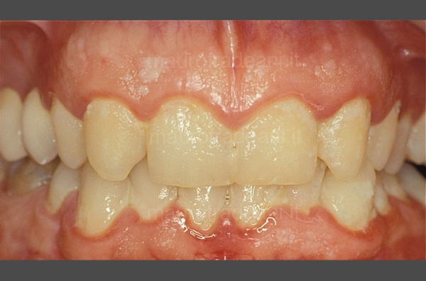 Clinical case of professional oral hygiene