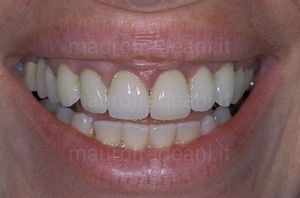 Ceramic crowns on implants clinical case