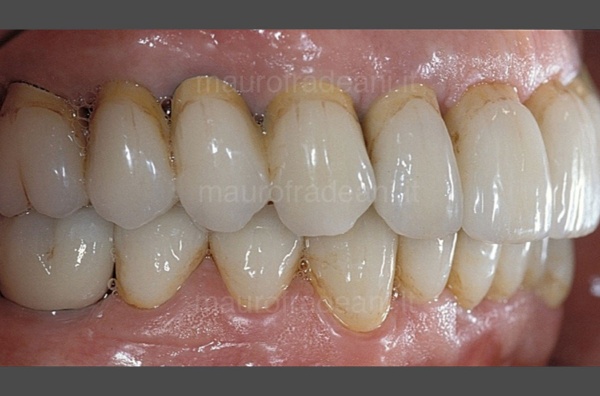 smile-makeover-before-and-after-on-implants-fradeani-clinical-case