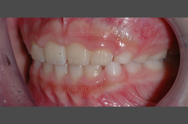 teeth-alignment-for-children-clinical-case-fradeani-clinic-after