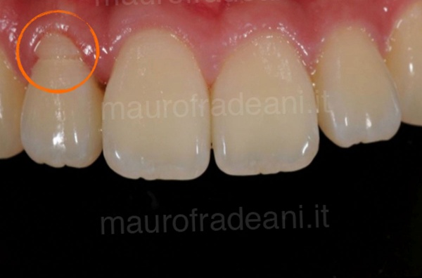 Clinical case of dental implant in the anterior sector