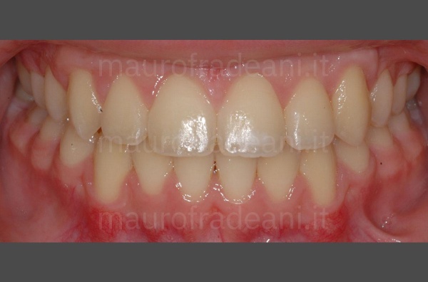 orthodontics-with-corticotomy-before-and-after-clinical-case-fradeani