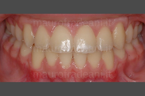 foto-post-trattamento-ortodontico