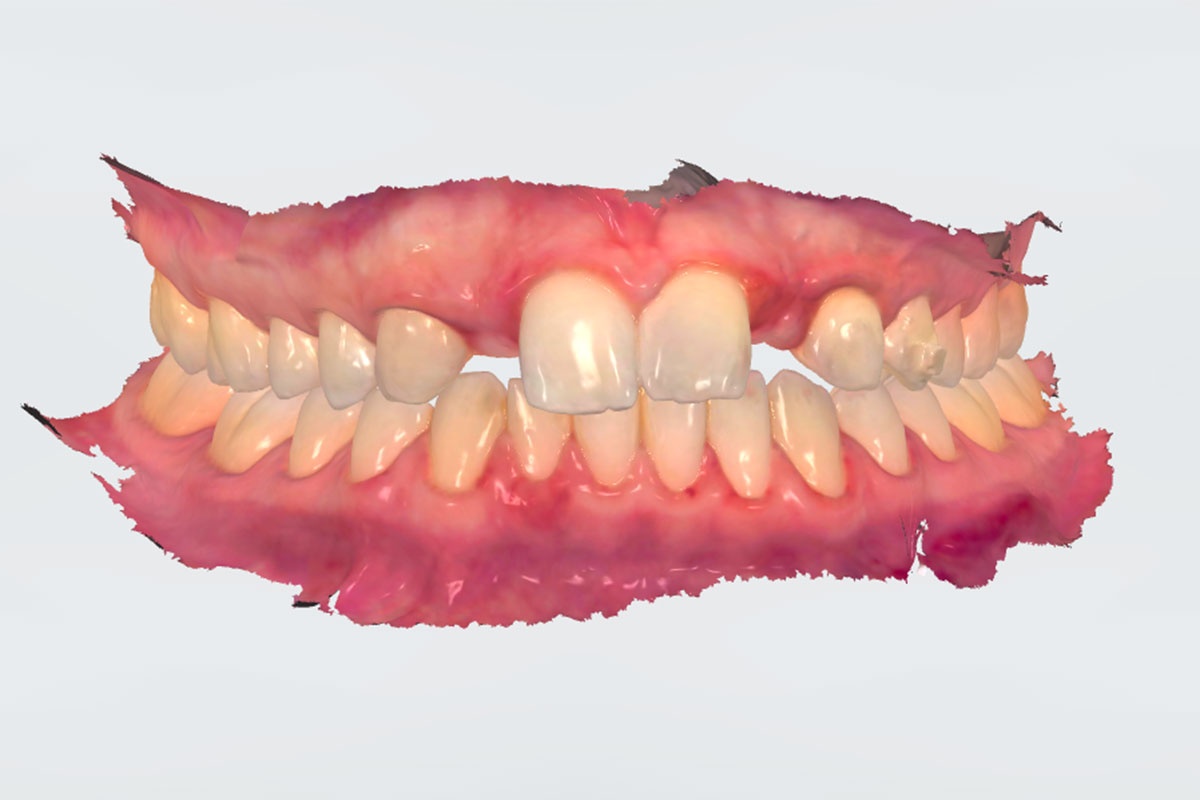 Impronta dentale digitale studio Mauro Fradeani Pesaro