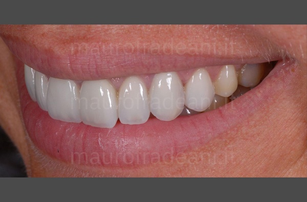 ceramic-veneers-for-discolouring-teeth-clinical-case-dr-mauro-fradeani-dental-clinic