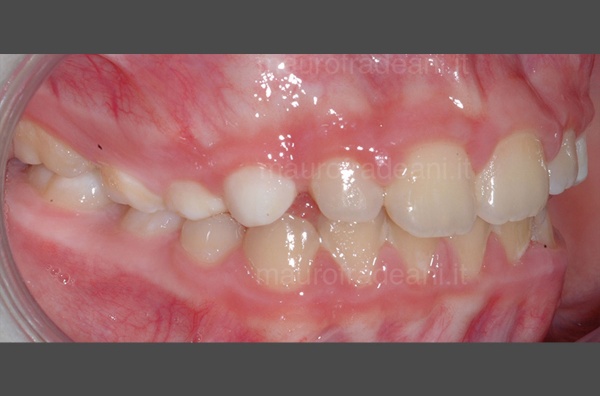 Dr. Fradeani early orthodontics clinical case