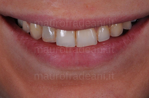 Anterior sextant ceramic veneers with agenesis and marked wear Dr. Fradeani