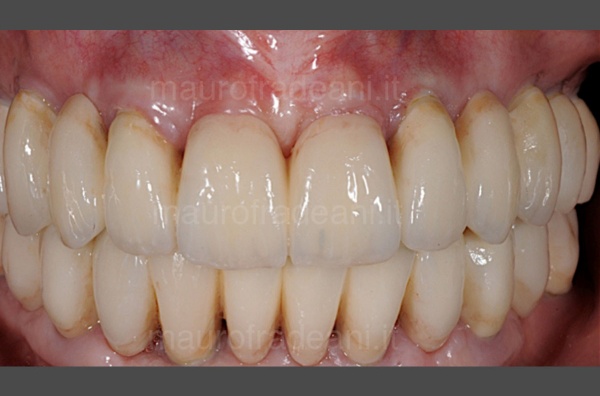 Clinical case of guided implantology Fradeani Dental Clinic