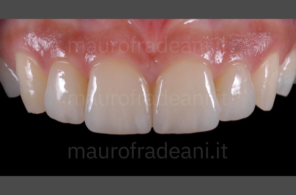 Dott. Mauro Fradeani caso clinico faccette dentali in ceramica per marcata usura dentale 