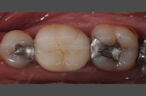 conservative-dental-care-clinical-case-dr-mauro-fradeani-italy