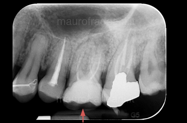 Endodontic clinical case: retreatment of an already devitalized tooth