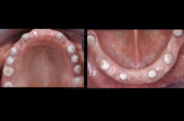 Dr. Mauro Fradeani clinical case of dental implantology 