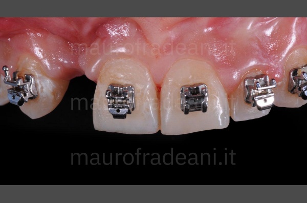 Clinical case anterior sextant ceramic veneers with agenesis and marked wear