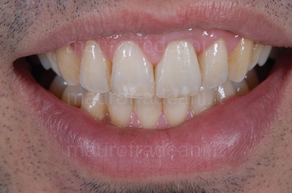 ceramic crown on anterior tooth implant clinical case Fradeani Dental Clinic 