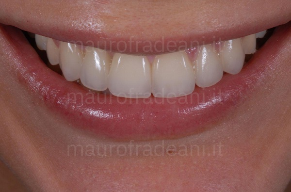 Dr. Fradeani clinical case anterior sextant ceramic veneers with agenesis and marked wear 