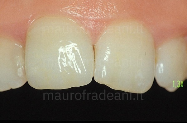 Dr. Mauro Fradeani ceramic crown on an anterior tooth already treated 