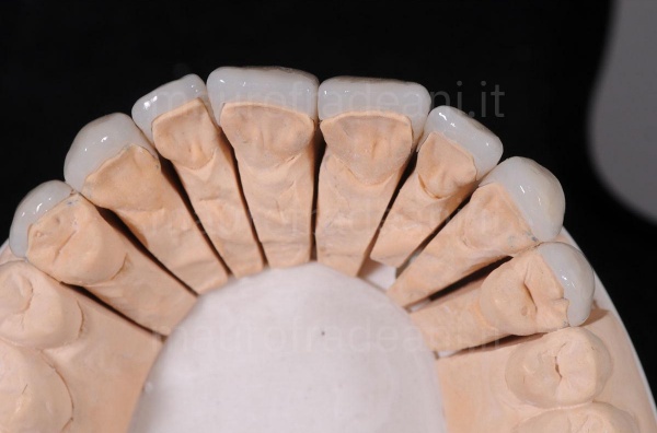 porcelain-dental-veneers-on-a-patient-with-discolouration