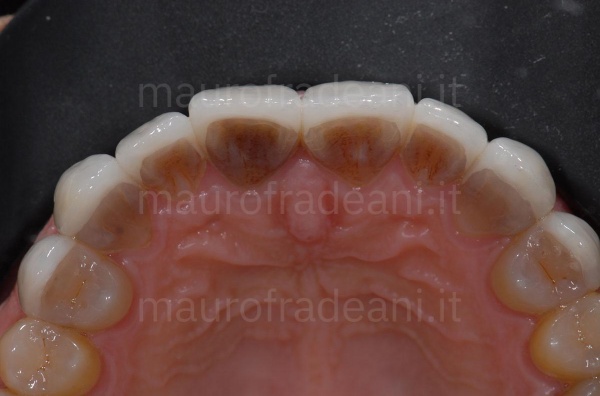 porcelain-dental-veneers-on-a-patient-with-discolouration-clinical-case-dr-mauro-fradeani