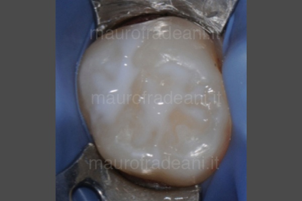 foto-odontoiatria-infantile-dopo-trattamento