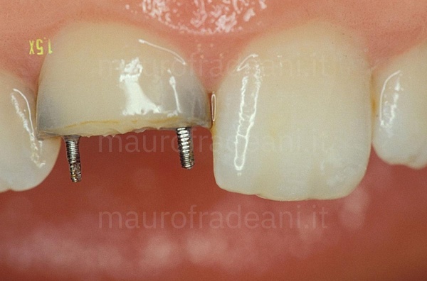 Clinical case ceramic crown on an anterior tooth already treated Dr. Mauro Fradeani