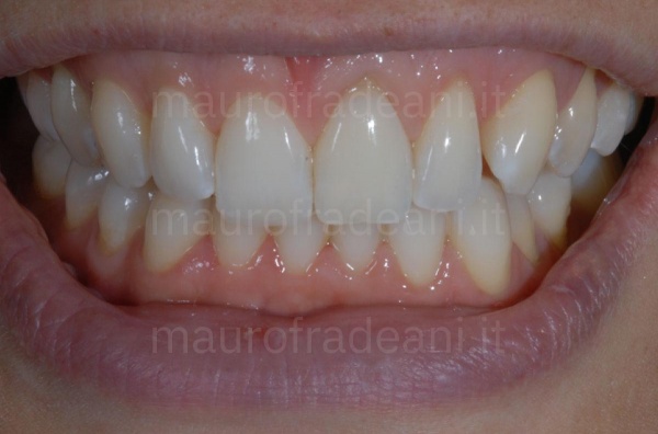 Whitening in office upper devitalized tooth 