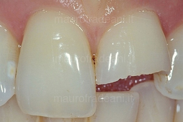 foto-pre-trattamento-odontoiatria-conservativa-estetica