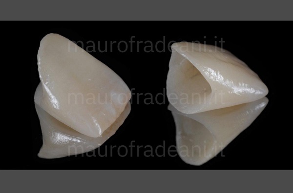 Dr. Mauro Fradeani ceramic crown on anterior tooth implant