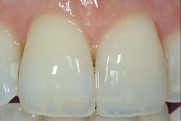 foto-post-trattamento-terapie-odontoiatriche-conservative