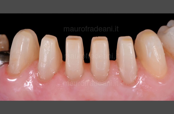 clinical-case-in-pre-prosthetic-orthodontics-fradeani-dental-clinic