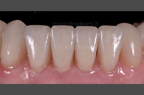 pre-prosthetic-orthodontics-clinical-case-dr-mauro-fradeani-specialised-dental-centre