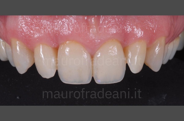 Upper teeth veneers clinical case Fradeani Dental Clinic