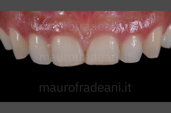 Ceramic dental veneers for marked dental wear clinical case Dr. Mauro Fradeani