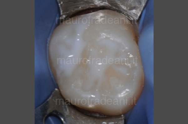 Dr. Fradeani clinical case sealings
