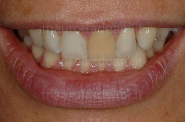 Clinical case whitening in office upper devitalized tooth