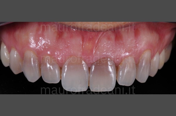 ceramic-veneers-for-discolouring-teeth-clinical-case-dr-mauro-fradeani-clinic