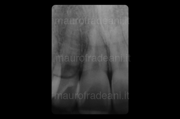 Clinical case of dental implant in the anterior sector Dr. Fradeani