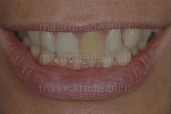 foto-prima-della-seduta-di-sbiancamento-dentale