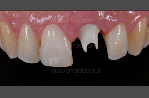 Dr. Mauro Fradeani ceramic crown on anterior tooth implant clinical case 