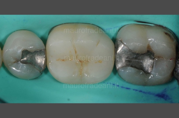 conservative-dental-care-clinical-case-dr-mauro-fradeani