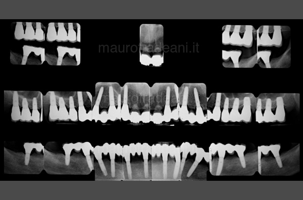 Fradeani Dental Clinic - Clinical case of guided implantology 